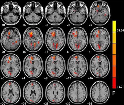 Interaction Between Smoking and Internet Gaming Disorder on Spontaneous Brain Activity